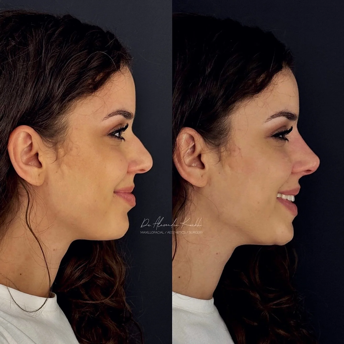 DR.K&rsquo;s Nose reshaping with dermal fillers is created for patients who need minor nasal remodeling but are not looking for a surgical rhinoplasty
.
Exclusively available at DR.K 👨🏼&zwj;⚕️
.
🎯 Treatment: Medical rhinocorrection based on long l