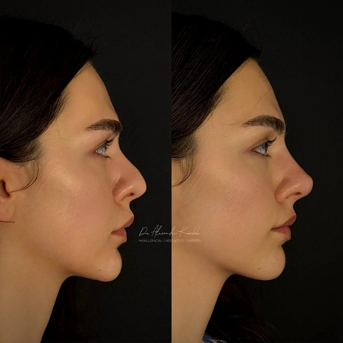 DR.K&rsquo;s Nose reshaping with dermal fillers is created for patients who need minor nasal remodeling but are not looking for a surgical rhinoplasty
.
Exclusively available at DR.K 👨🏼&zwj;⚕️
.
🎯 Treatment: Medical rhinocorrection based on long l