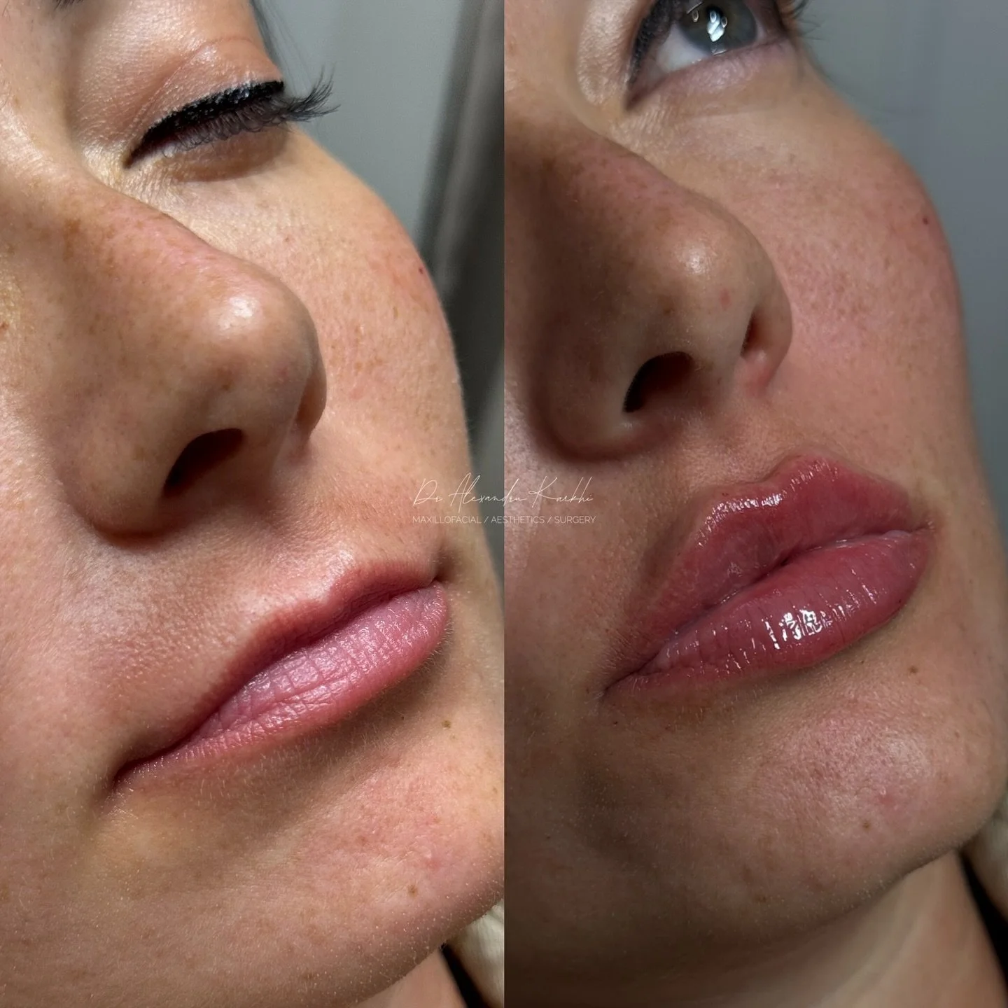 DR.K Flat Lips 💉👄

Exclusively available at CLINICA DR.K Medical Centers ⚜️

😷 Treatment: Non-surgical Lips enhancement
🎯 Purpose: to project and to create the right proportions of the upper and lower Lips with a flat profile design
👓 How it wor
