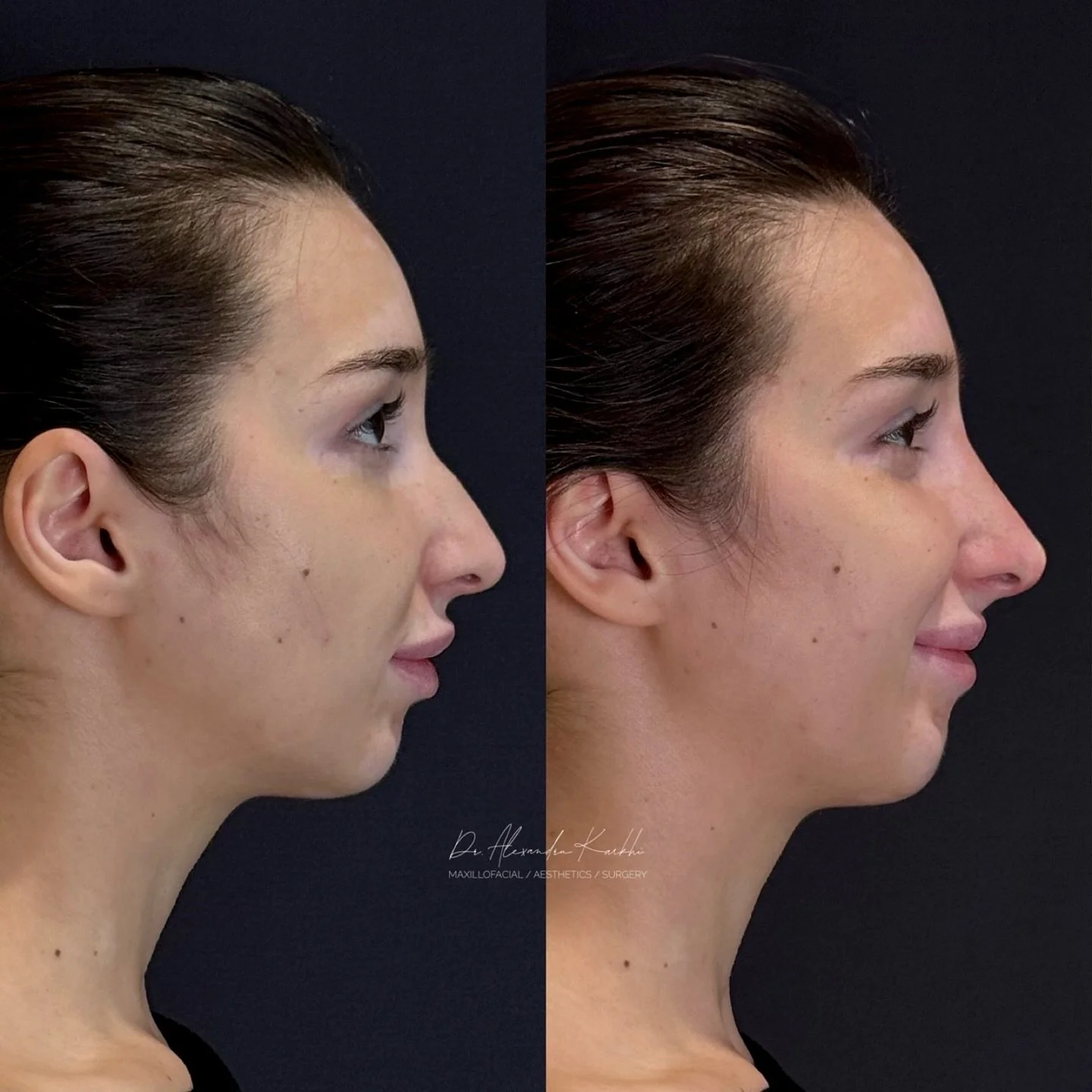 DR.K&rsquo;s Nose reshaping
.
Exclusively available at DR.K 👨🏼&zwj;⚕️
.
🎯 Treatment: DR.K&rsquo;s Medical Rhinocorrection based on long lasting dermal fillers is created for patients who need minor nasal remodeling but are not looking for a surgic