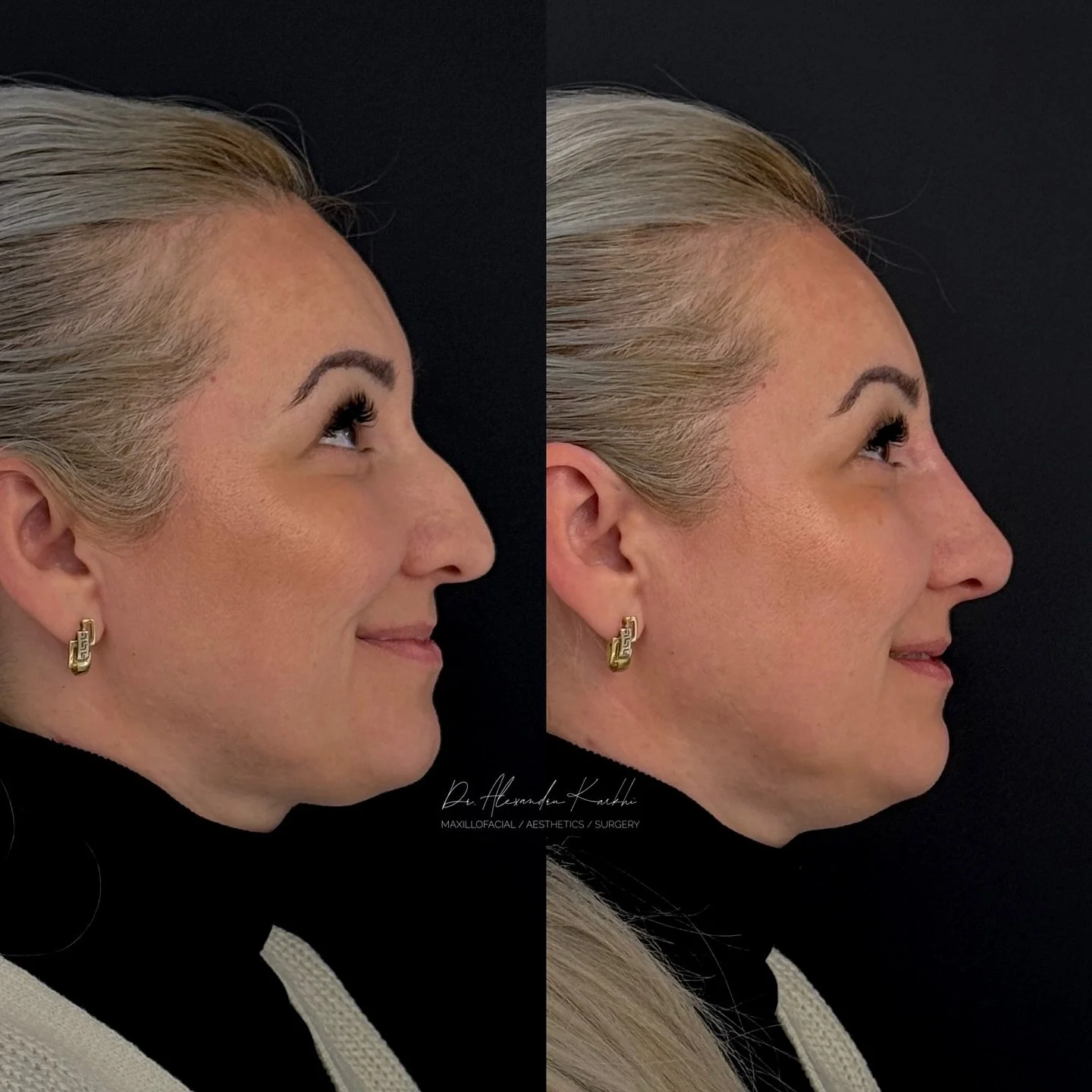 DR.K&rsquo;s Nose Reshaping
.
Exclusively available at DR.K 👨🏼&zwj;⚕️
.
🎯 Treatment: DR.K&rsquo;s Medical Rhinocorrection based on long lasting dermal fillers is created for patients who need minor nasal remodeling but are not looking for a surgic
