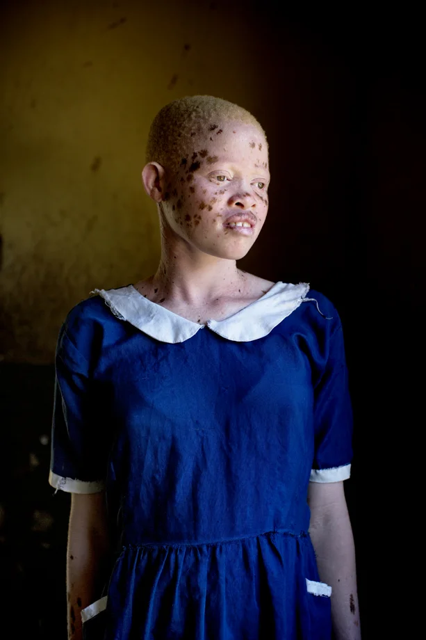 Albino girl who lives in sheltered accommodation, Malawi