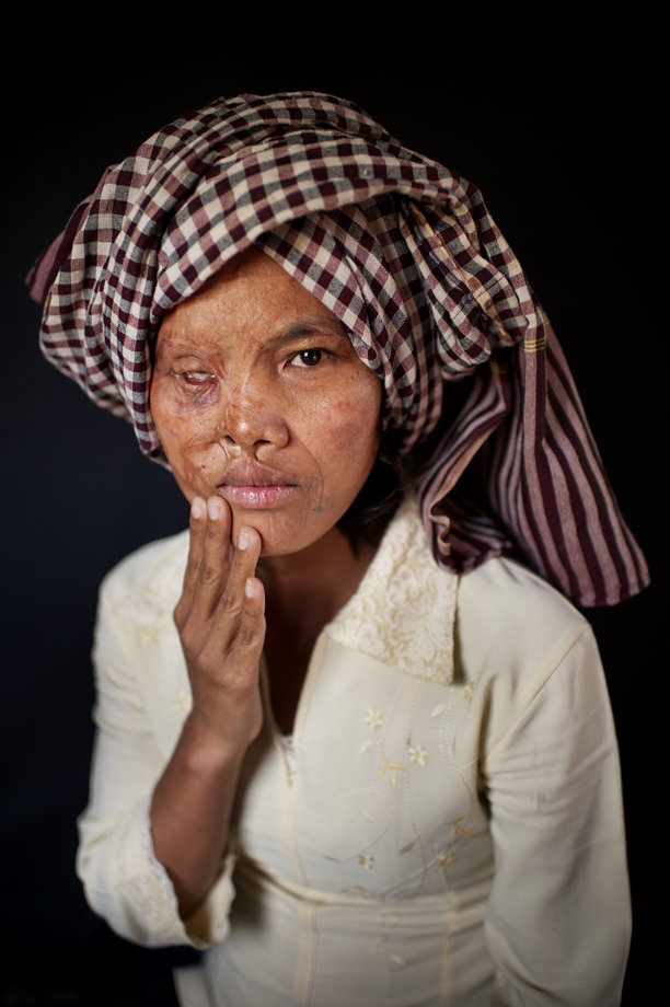  Acid attack survivor, Phnom Penh / Cambodia 