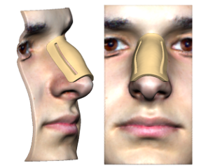 Patient-specific marking templates for rhinoplasty streamline dorsal hump removal by increasing incision precision.