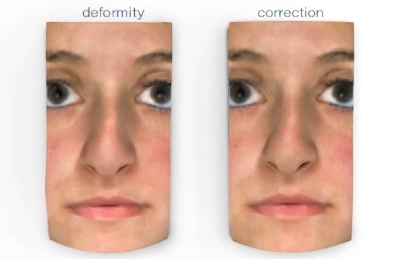 2 Dorsal Hump Reduction Example.png