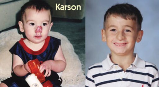 Karson before and after his reconstructive surgery for congenital hemangioma. ( Source )