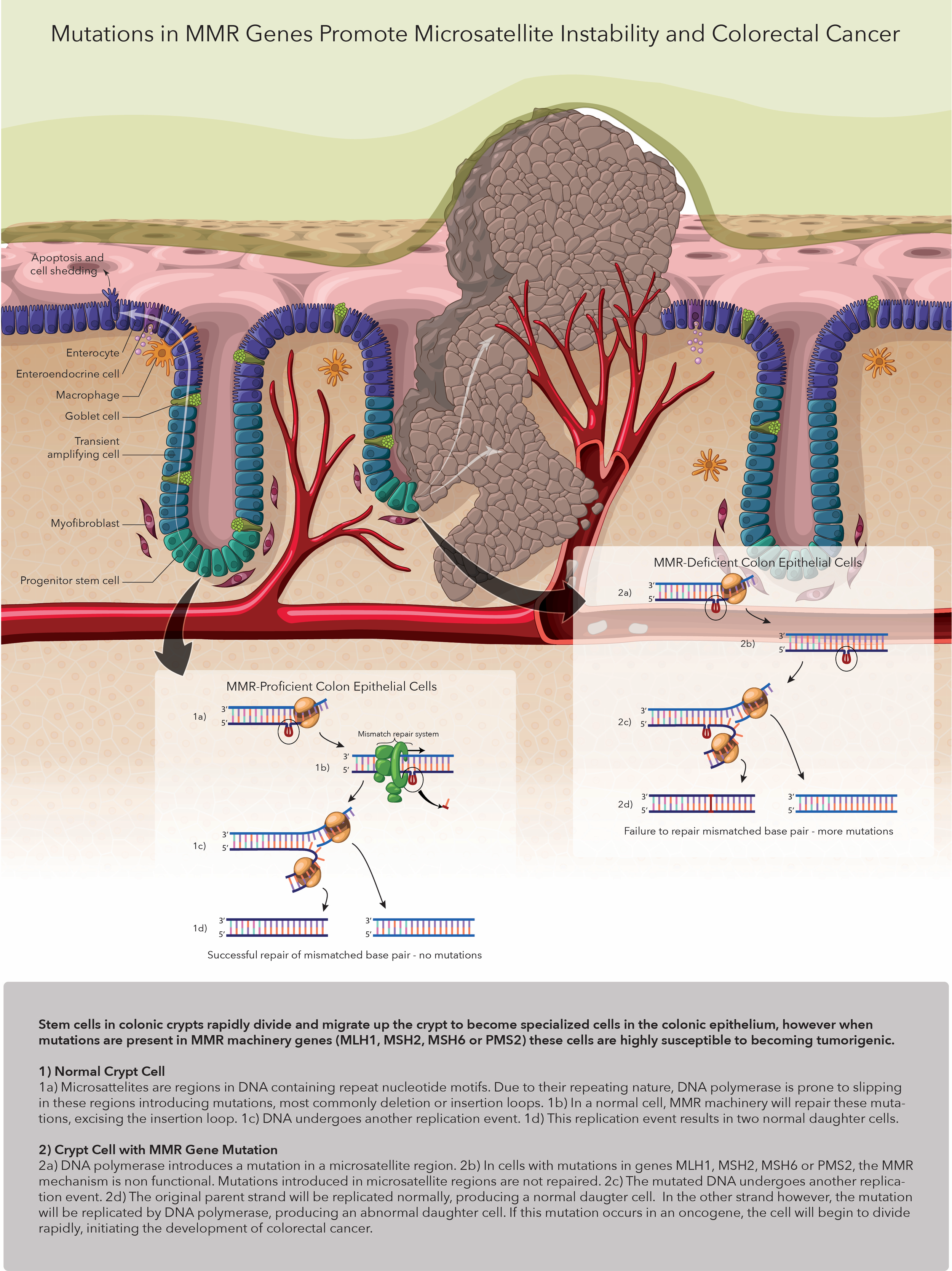 Figure 2. Genetic mutations resulting from MMR deficiency contribute to CRC Development by Lauren Huff