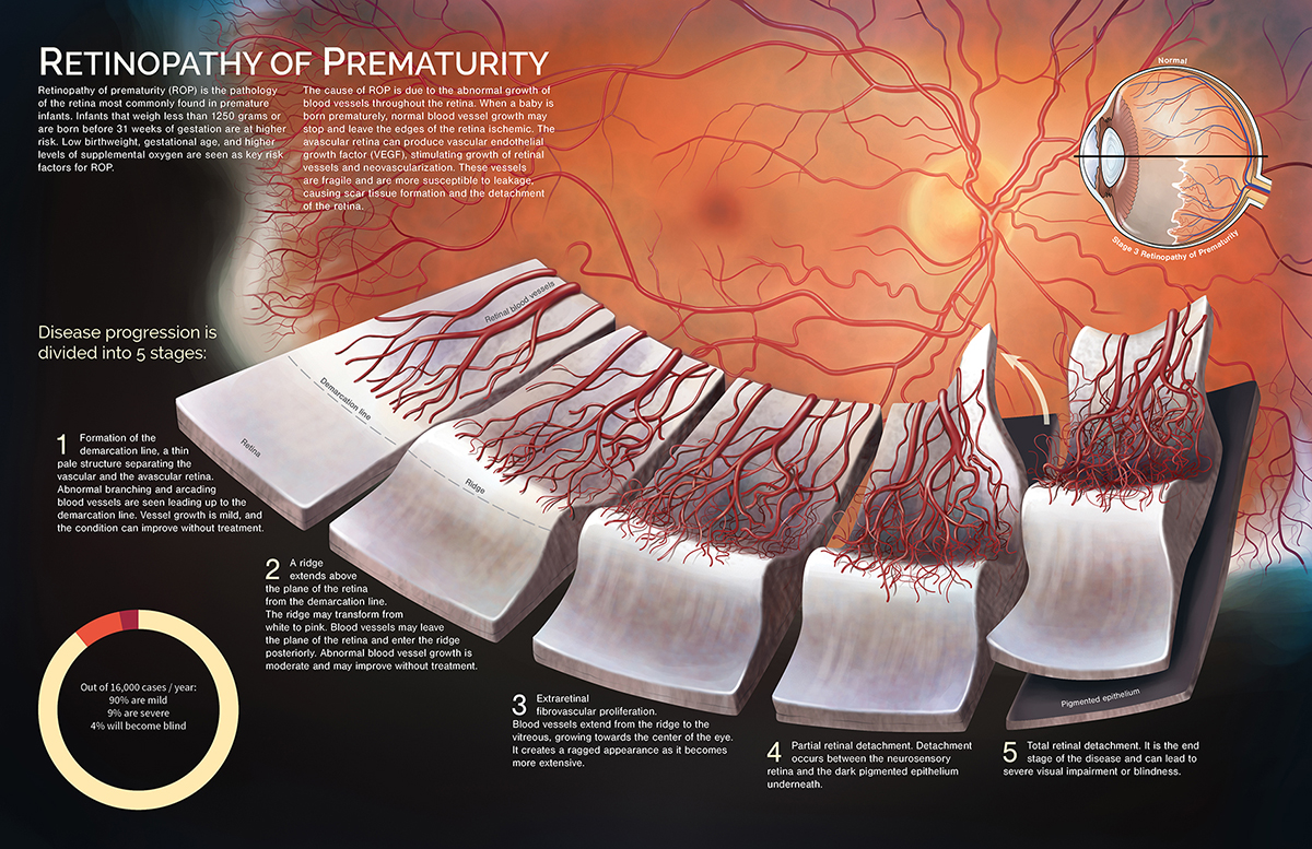 Retinopathy of Prematurity by Wendy (1T6) Gu