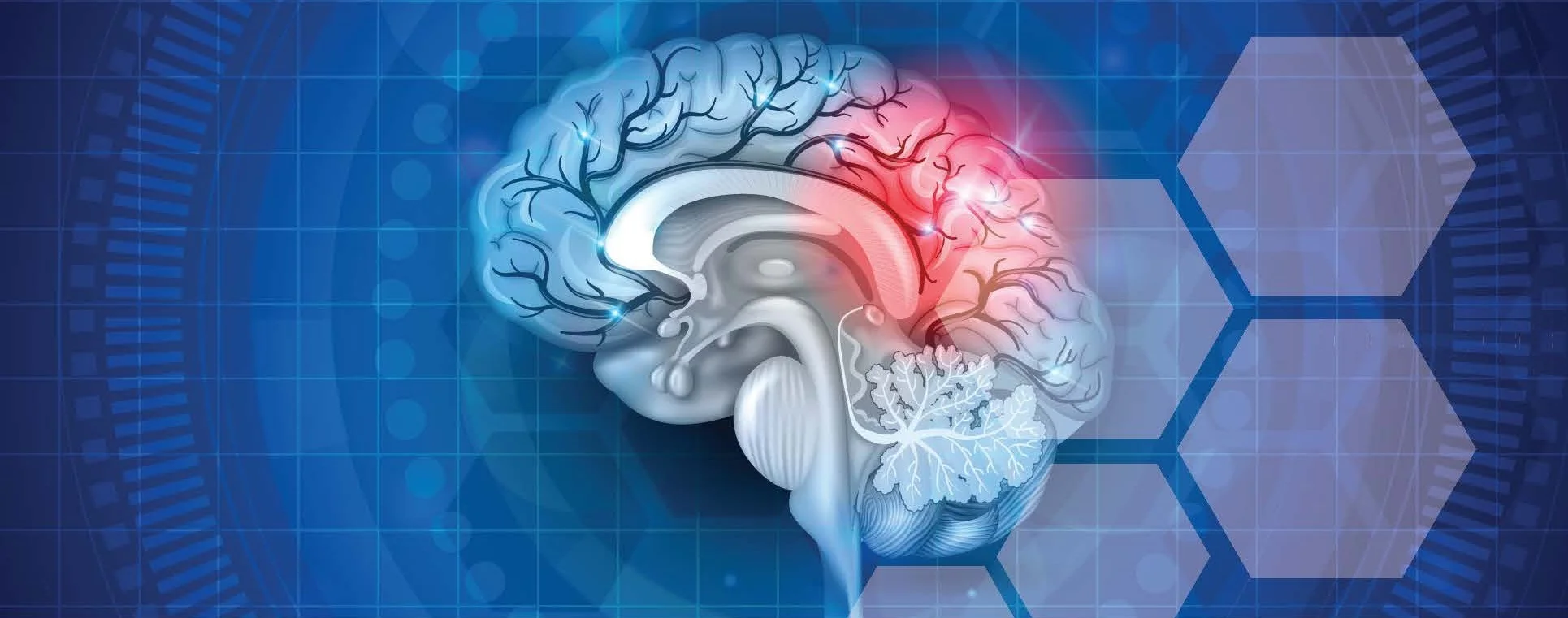 A Rare-Disease Approach to Seizure Treatment