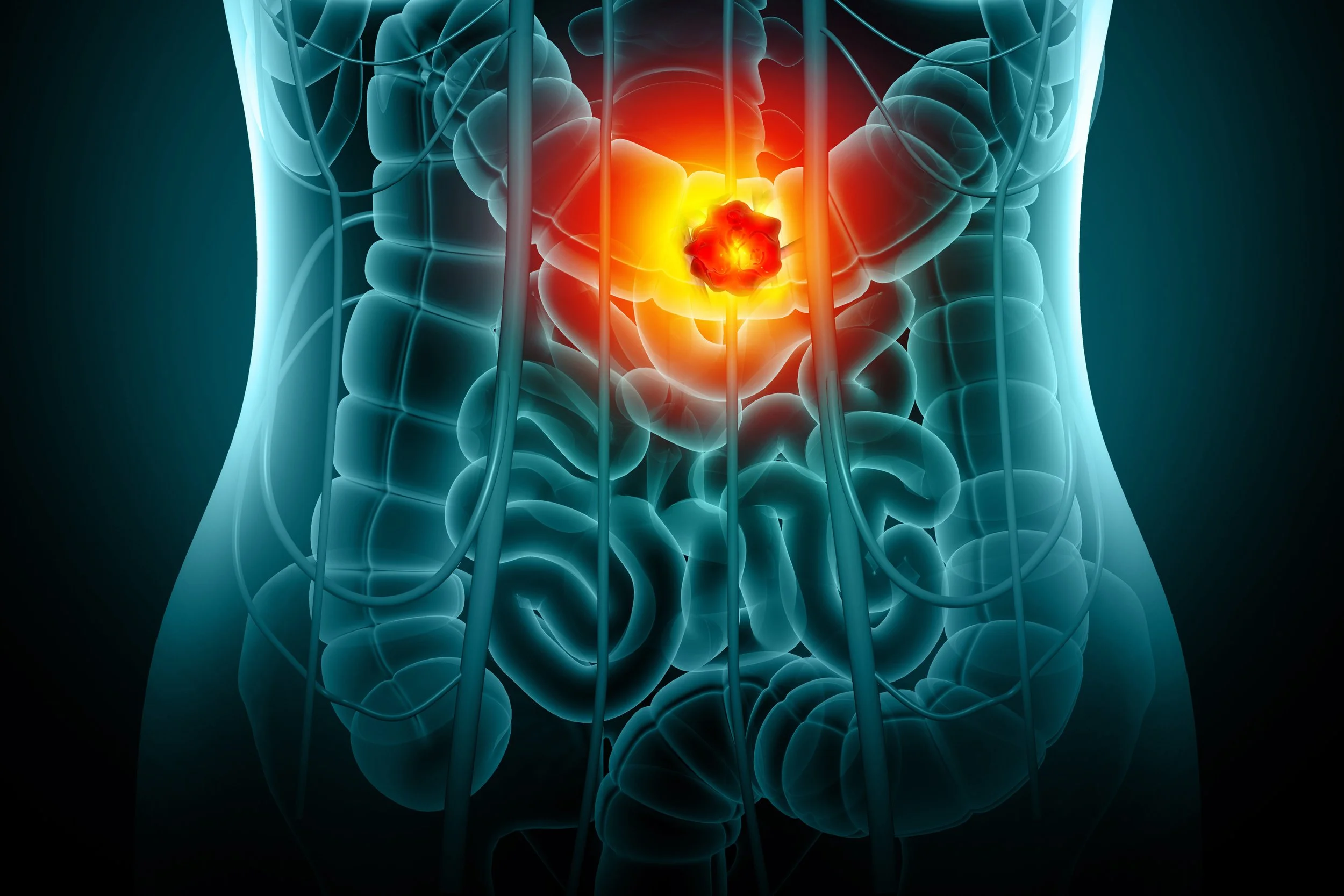 The Case for a New Generation of Oral Therapies in Inflammatory Bowel Disease - Back Bay Life Science Advisors and Nimbus Therapeutics 