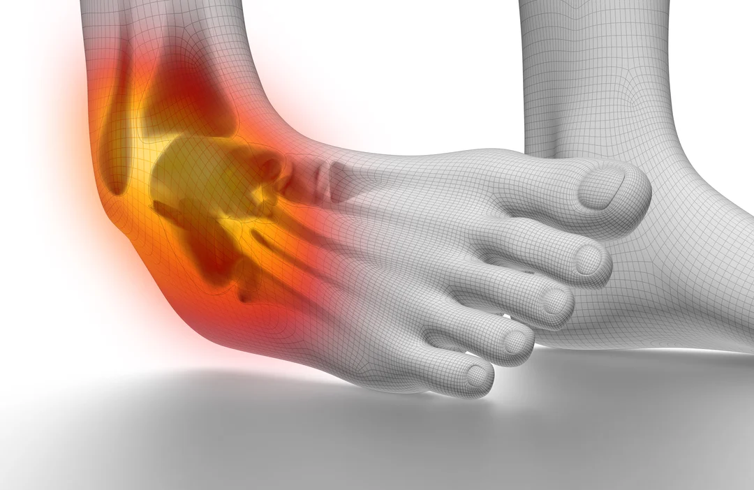 AMIT and Achilles Tendonitis