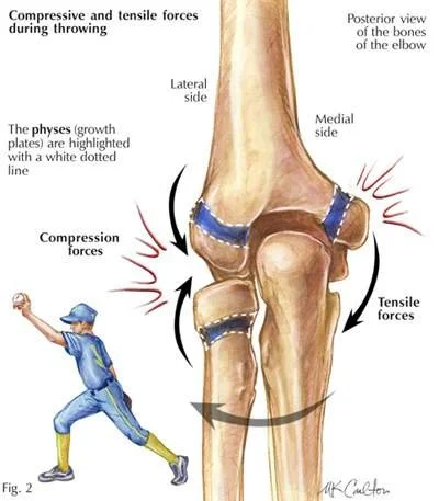 Little League Elbow Explained