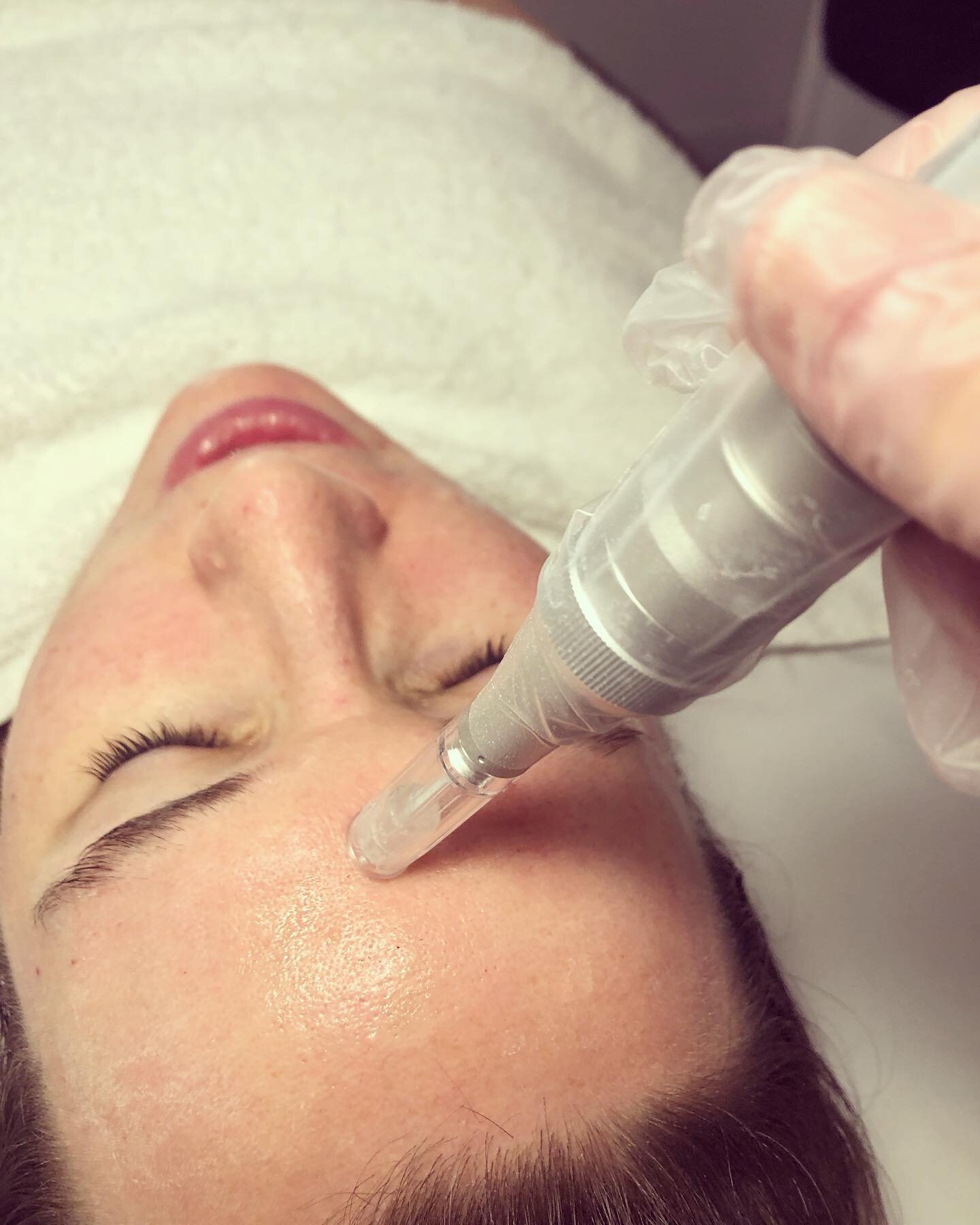 Microneedling evens out imperfections and will tighten skin!!
Try it for $249 from $340.  Purchase before March 22nd but use anytime!  #twodayspecial #tightskin #glowingskin
