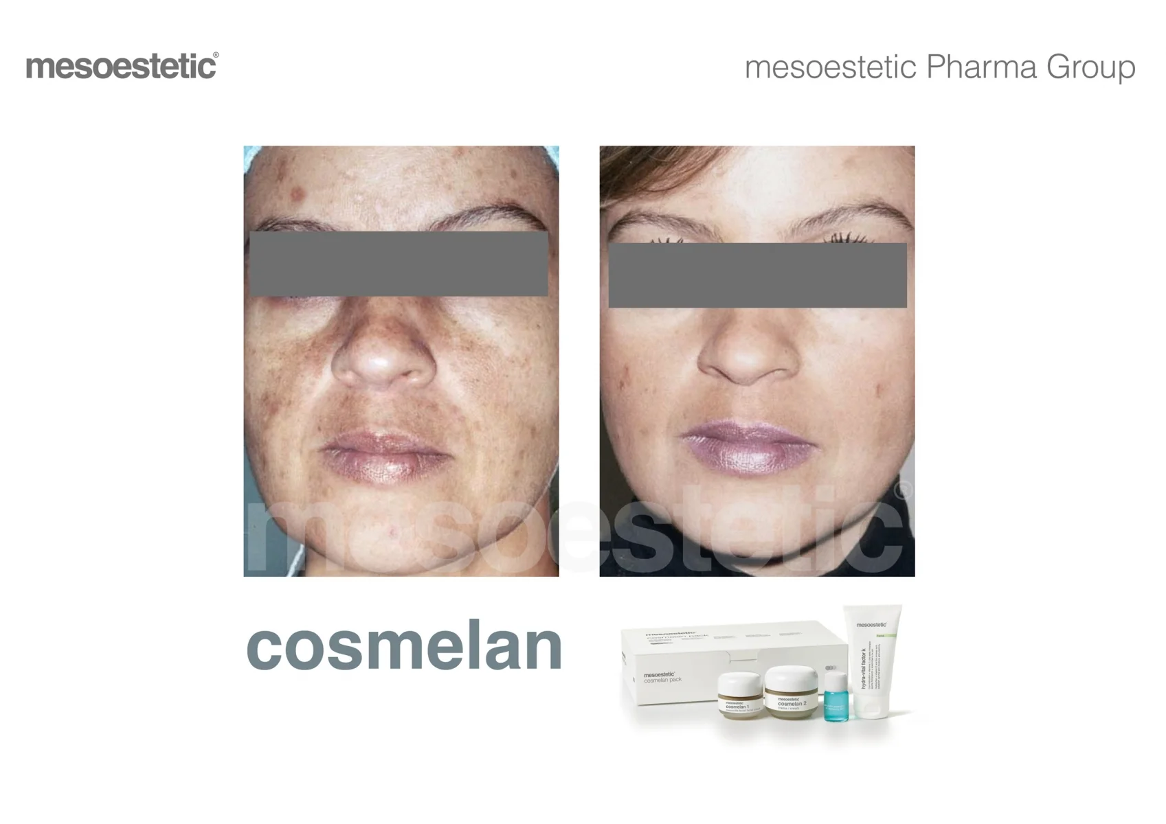 cosmelan-antesdespues-3_c71.jpg