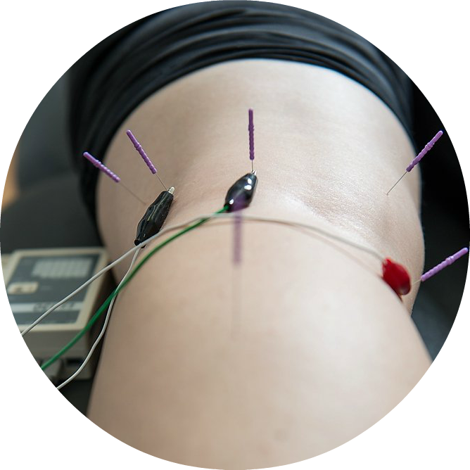 Acupuncture | Dry Needling