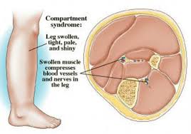 Compartment Syndrme 2.jpg