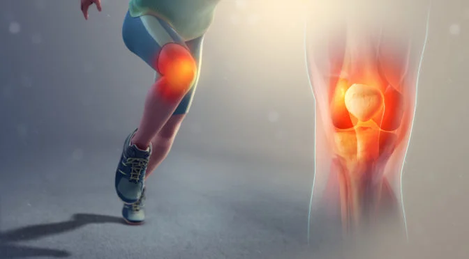 Patella Femoral Pain Syndrome1.jpg