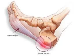 Plantar Fascitis2.jpg