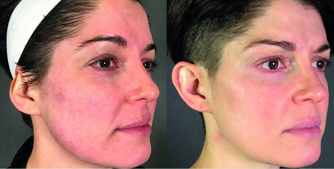 Left before - Right after