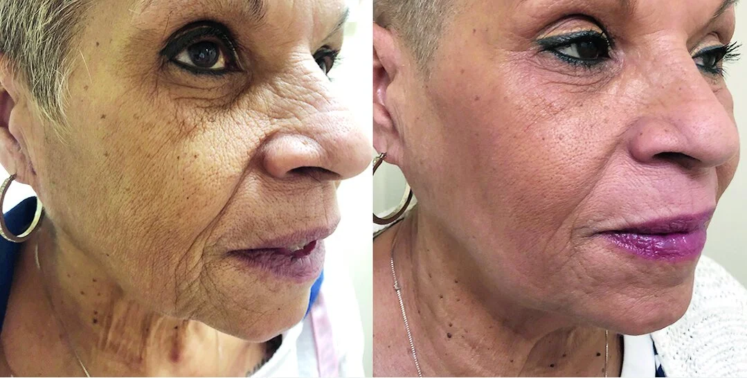 Left before - Right after