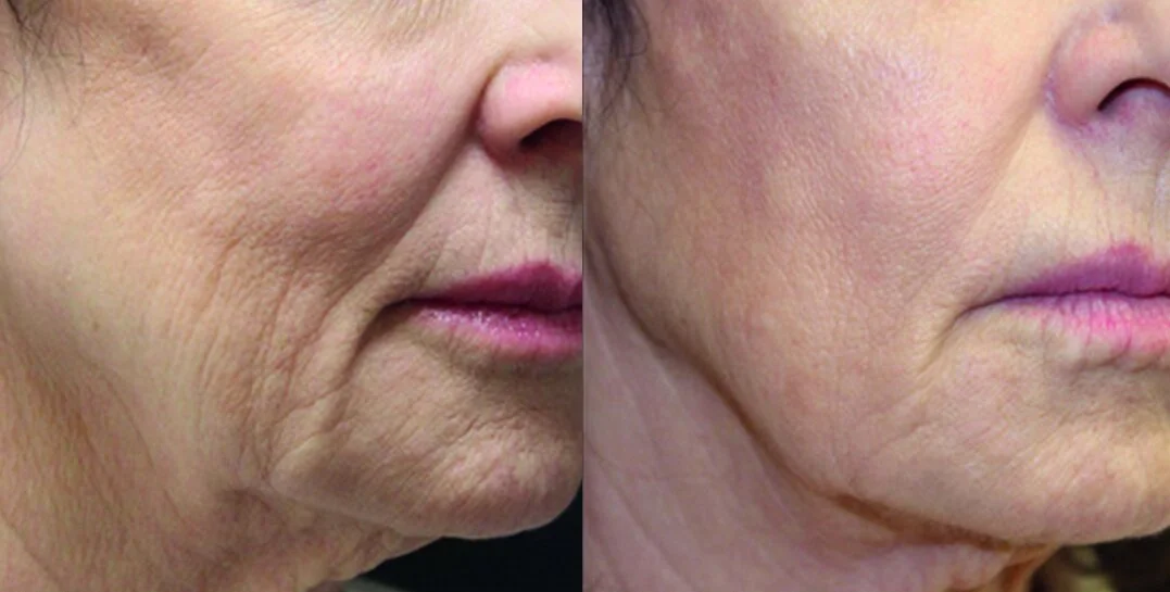 Left before - Right after