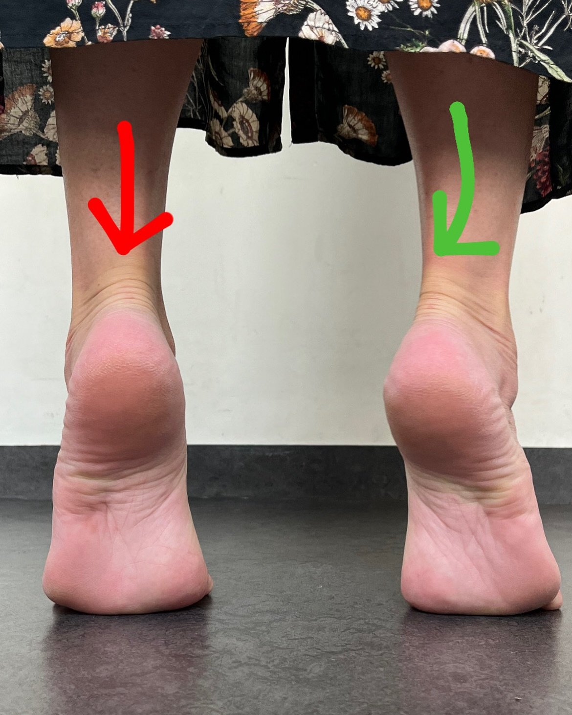Posterior Tibialis appreciation post.

Here you see an assessment of the Posterior Tibialis in a closed chain assessment. In double heel rise we can see a clear difference between the left and right. 

Main functions of the Posterior Tibialis is:

🔸