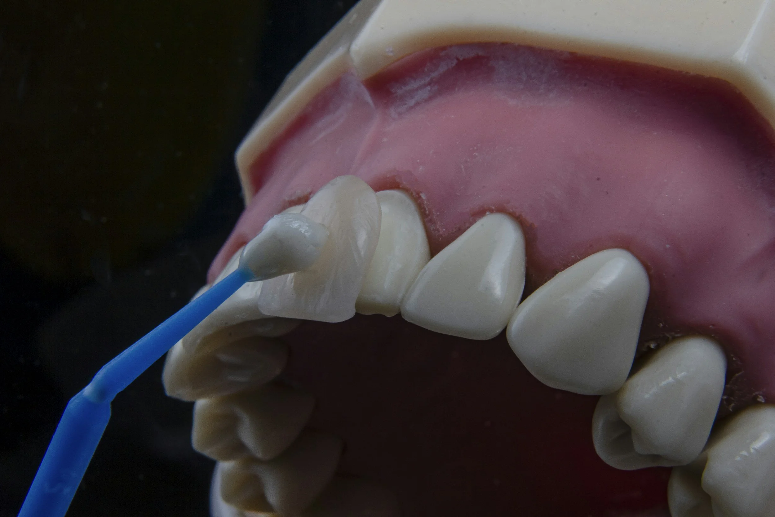 Dental model with teeth, pink gums, and a toothbrush cleaning the back molar.