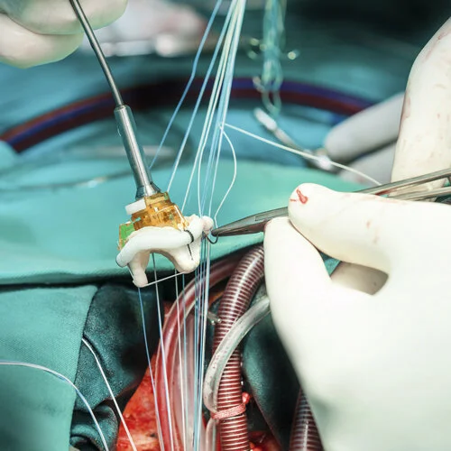 Plexxus and Mohawk Medbuy See Ongoing Successes with Large-Scale Joint RFPs