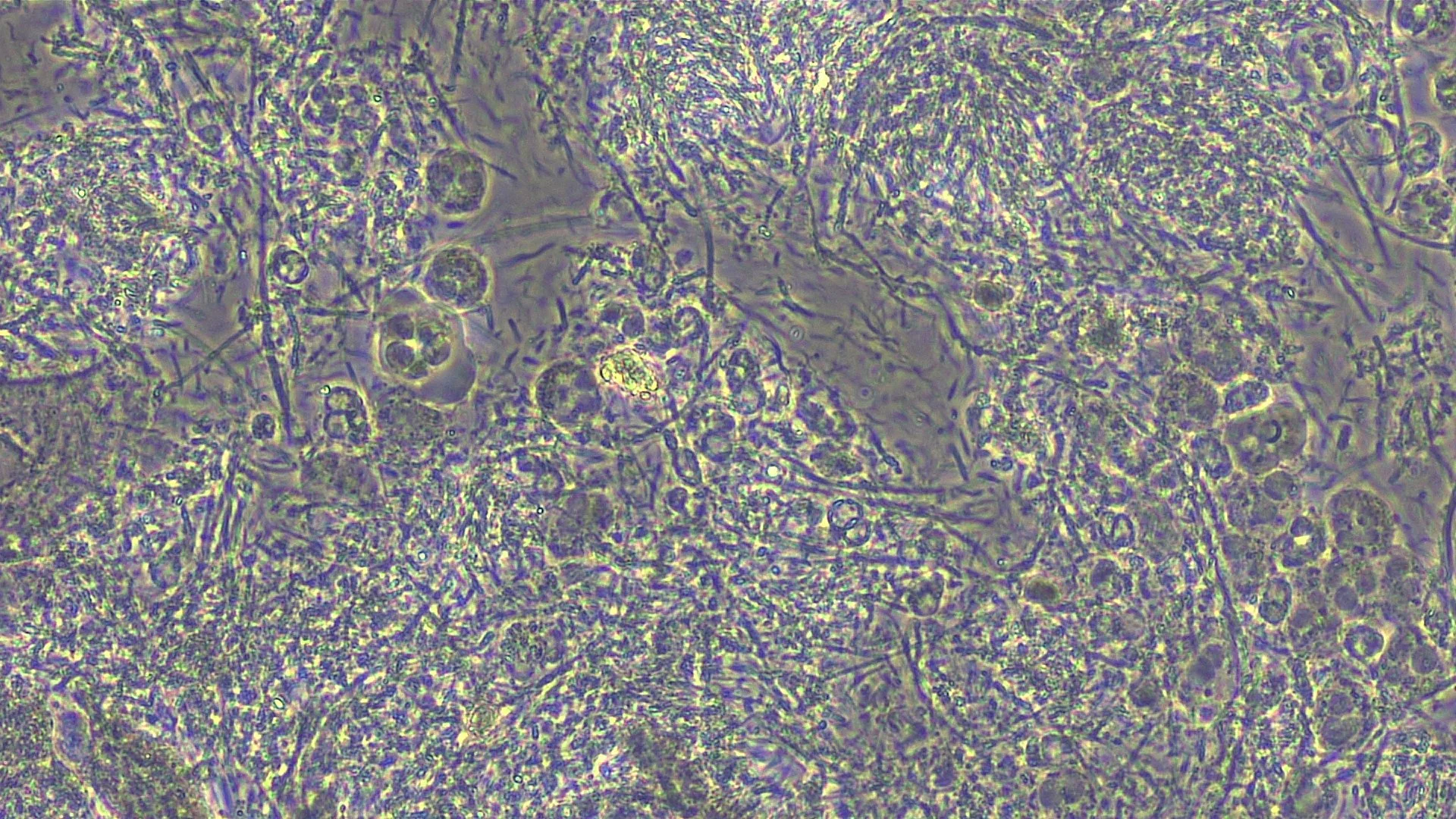  Quelles sont les bactéries responsables de la parodontite ?