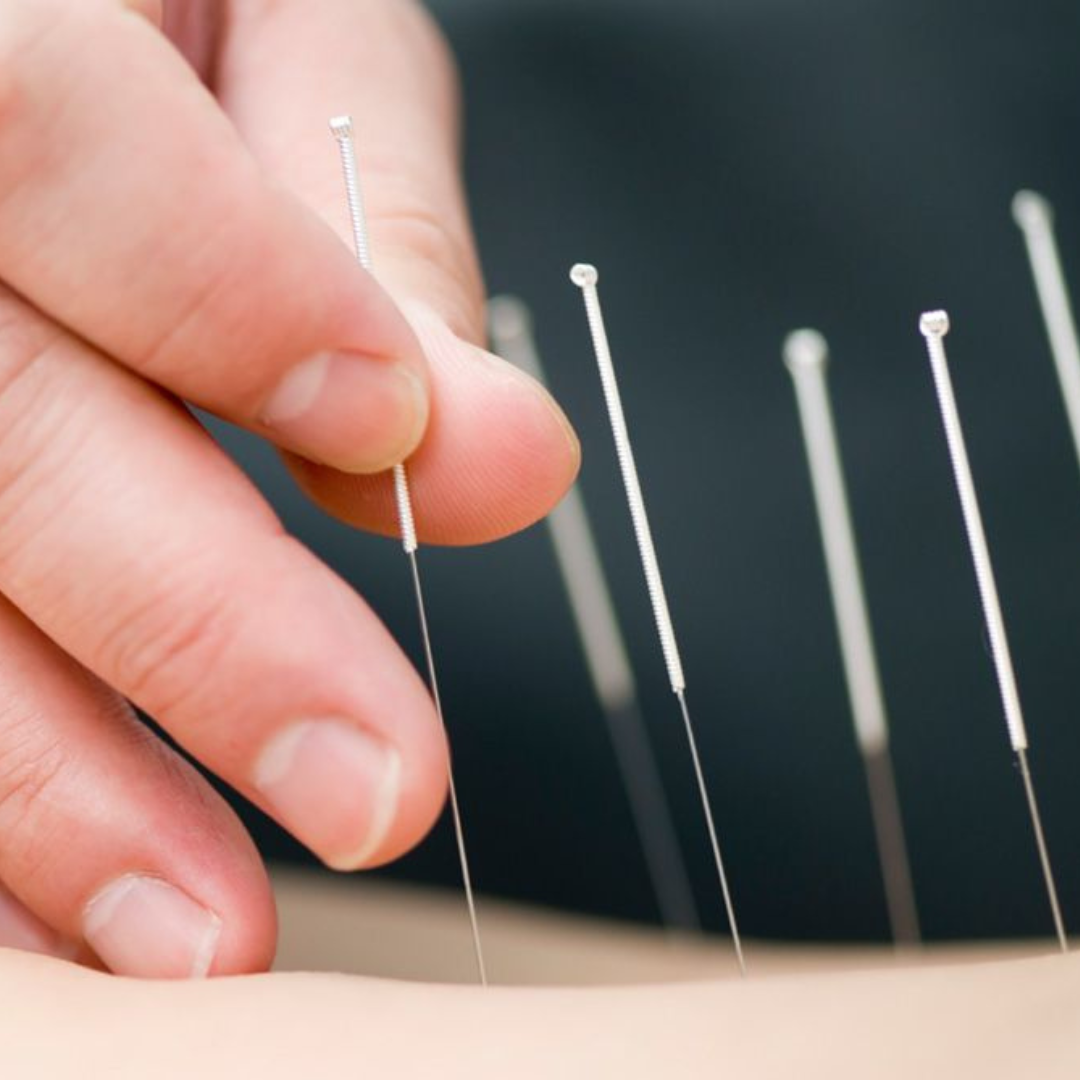 Acupuncture 1.png