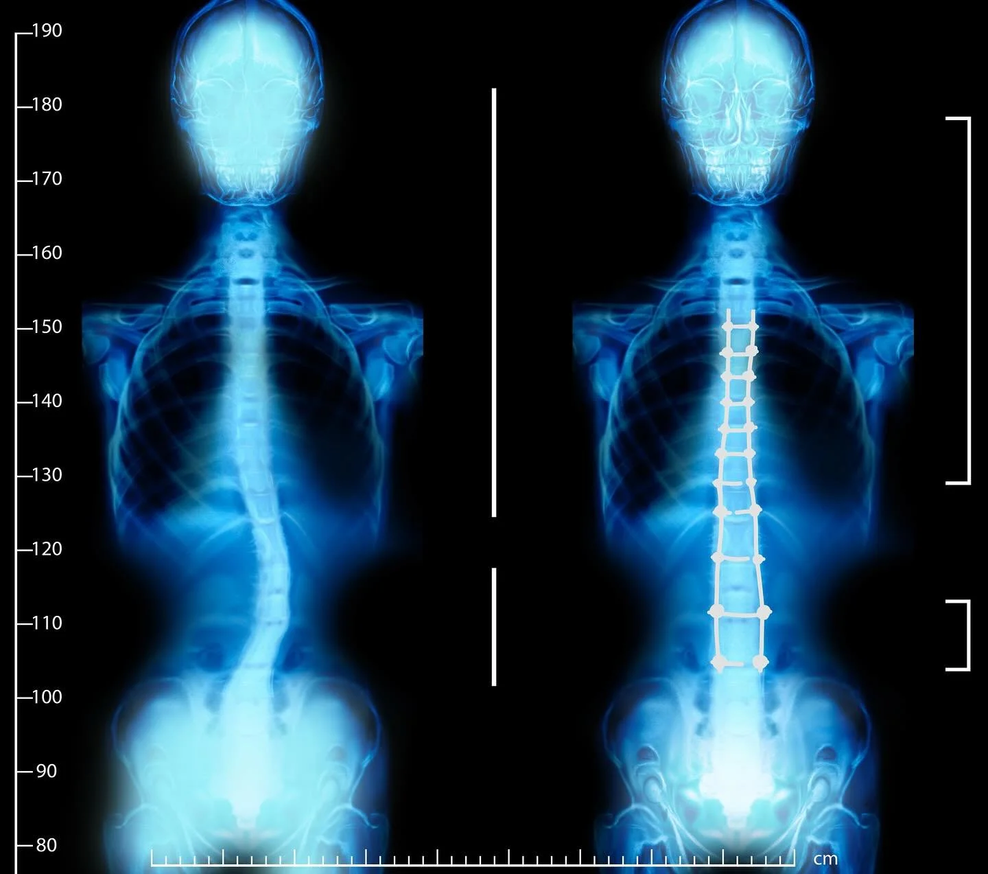 🌿 Find Comfort in Every Angle! 🩻

Scoliosis doesn&rsquo;t have to hold you back. At Sore Spots, our skilled RMTs and Chiropractor offer personalized care to ease spinal tension, enhance posture, and support healthy alignment. Regain your confidence