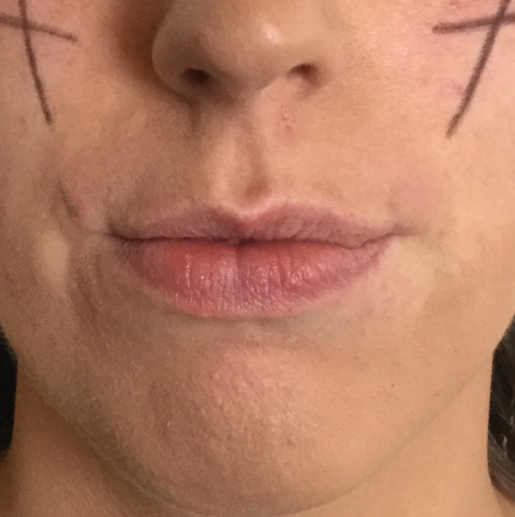 Lip_fillers-01.jpg