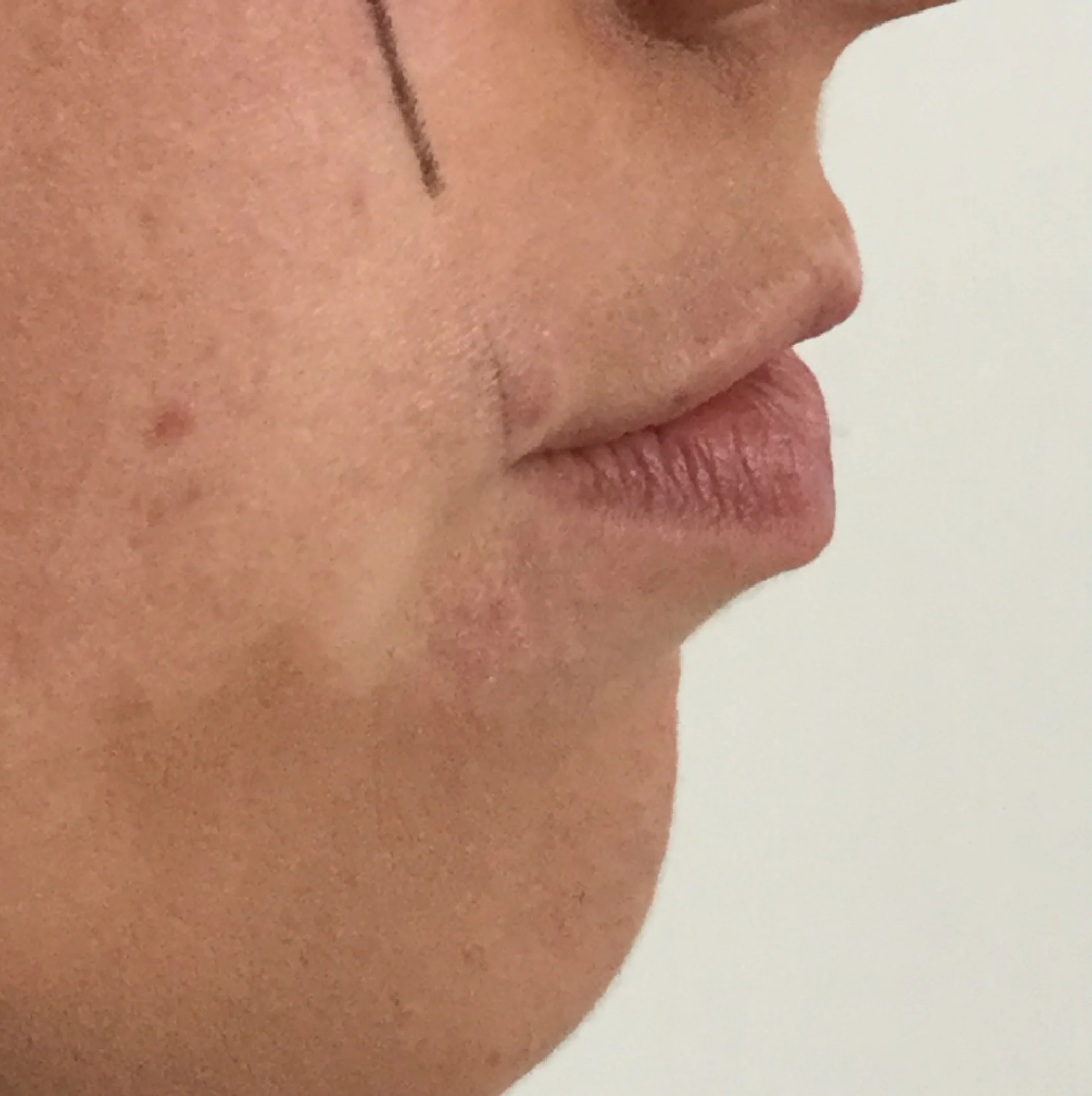 Lip_fillers-04.jpg