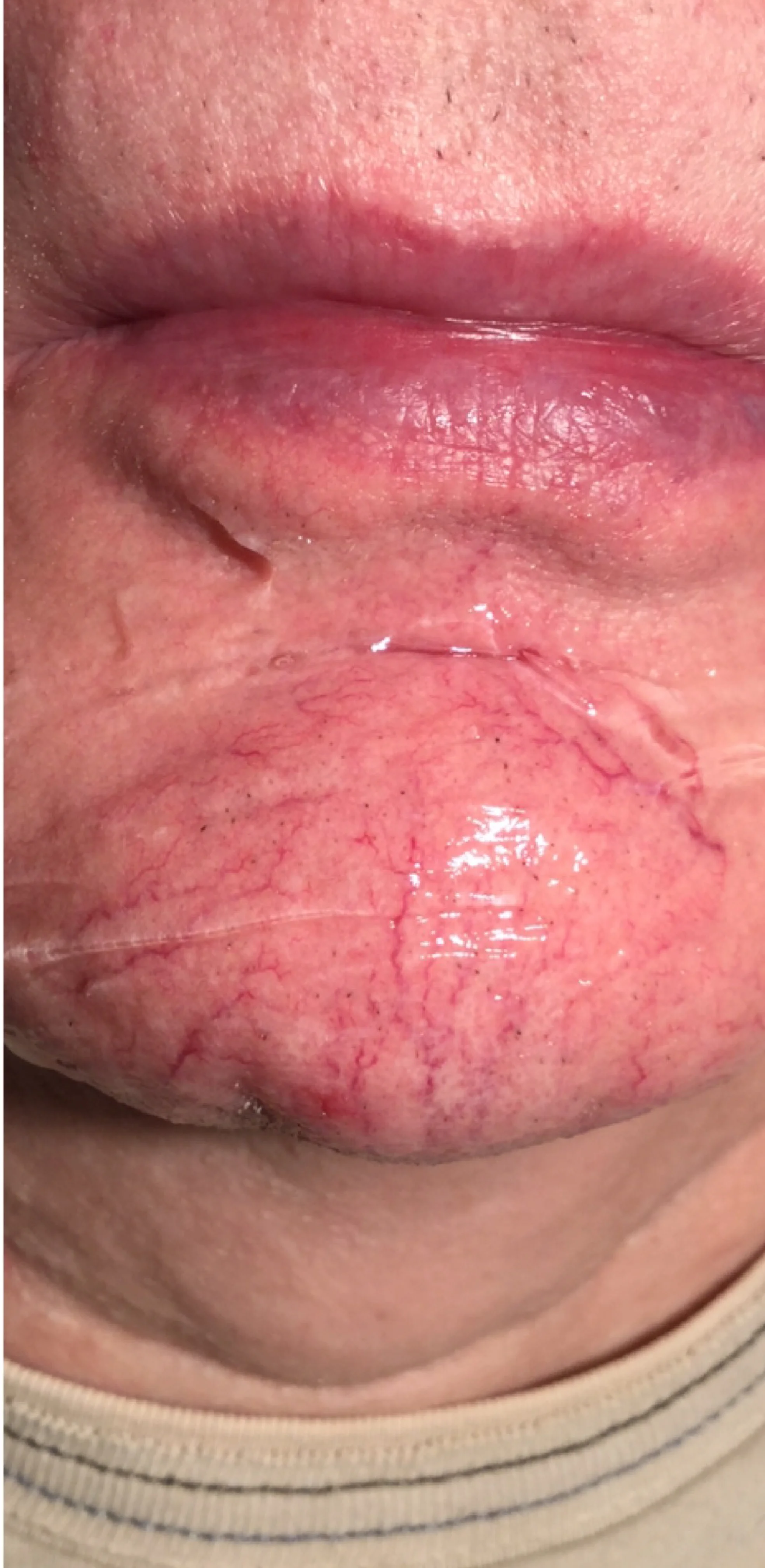 Lip_fillers-05.jpg