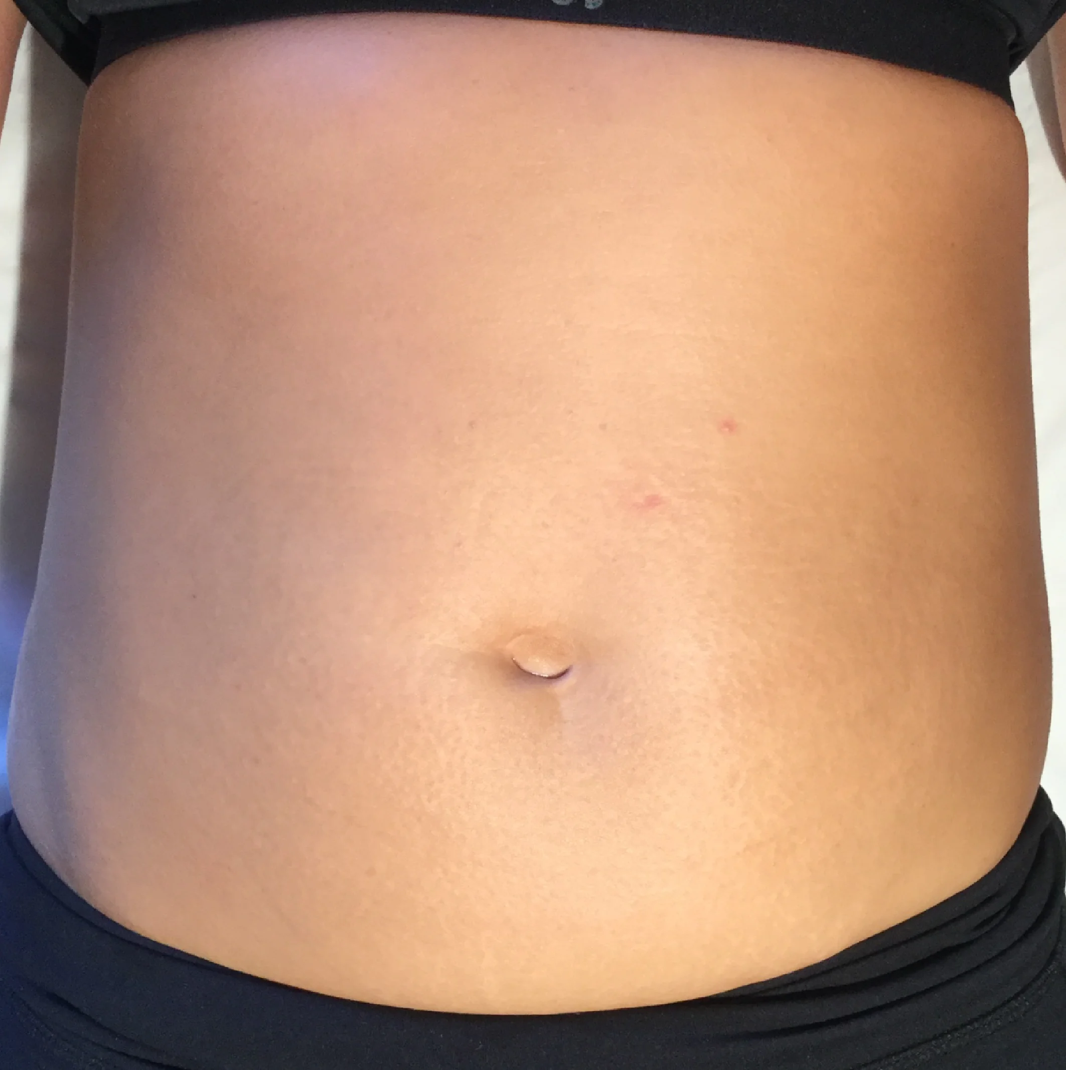 Stretch marks-02.jpg