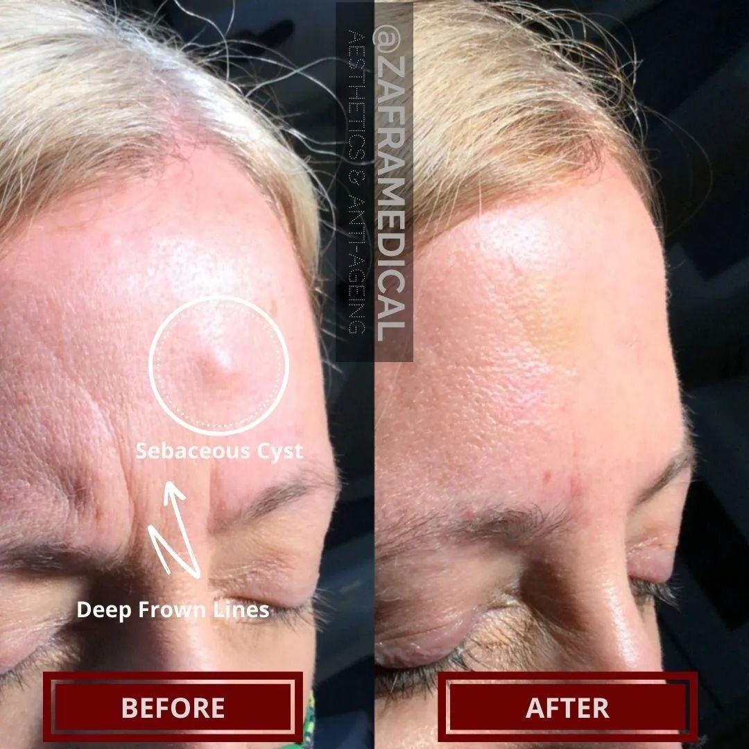 Yes this is possible without surgery in the expert hands of @doctorzafra 
🤩
A sebaceous cyst is a bening skin lesion that can be life changing if they are very noticeable🧐
💫
Traditional methods involved cutting and resulted in a large scar👎
💡
👍