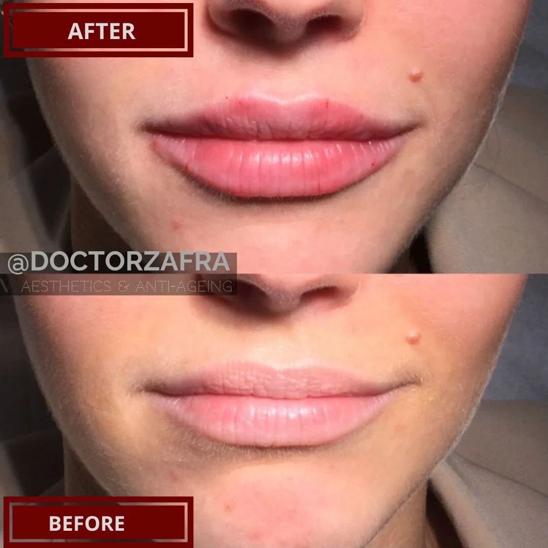 My hardest challenge are young beautiful lips that only need a bit of hydration and plumping up 😍 so nobody call tell they have been done and I become the secret of many 😉
🎉
Love my job!
 💡
Dermal fillers done can actually really look natural not