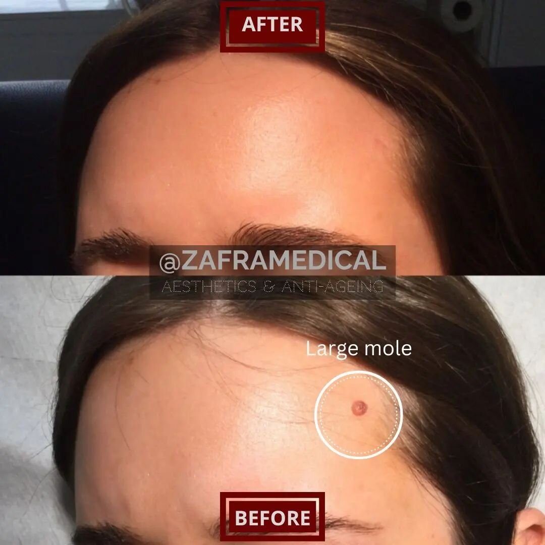 Another clear example this is possible without surgery in the expert hands of @doctorzafra 
🤩
Moles and bening skin lesions can be life changing if they are very noticeable🧐
💫
Traditional methods involved cutting and resulted in a large scar👎
💡
