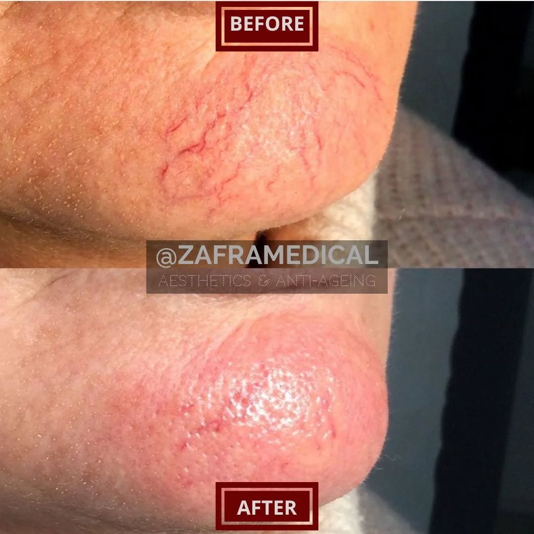 Thread veins or spider veins can be very localised on the chin area, and are difficult to cover up with makeup.
💫
Fortunately there are two ideal treatment options, laser or injectable solution like in this case where you can see the immediate resul