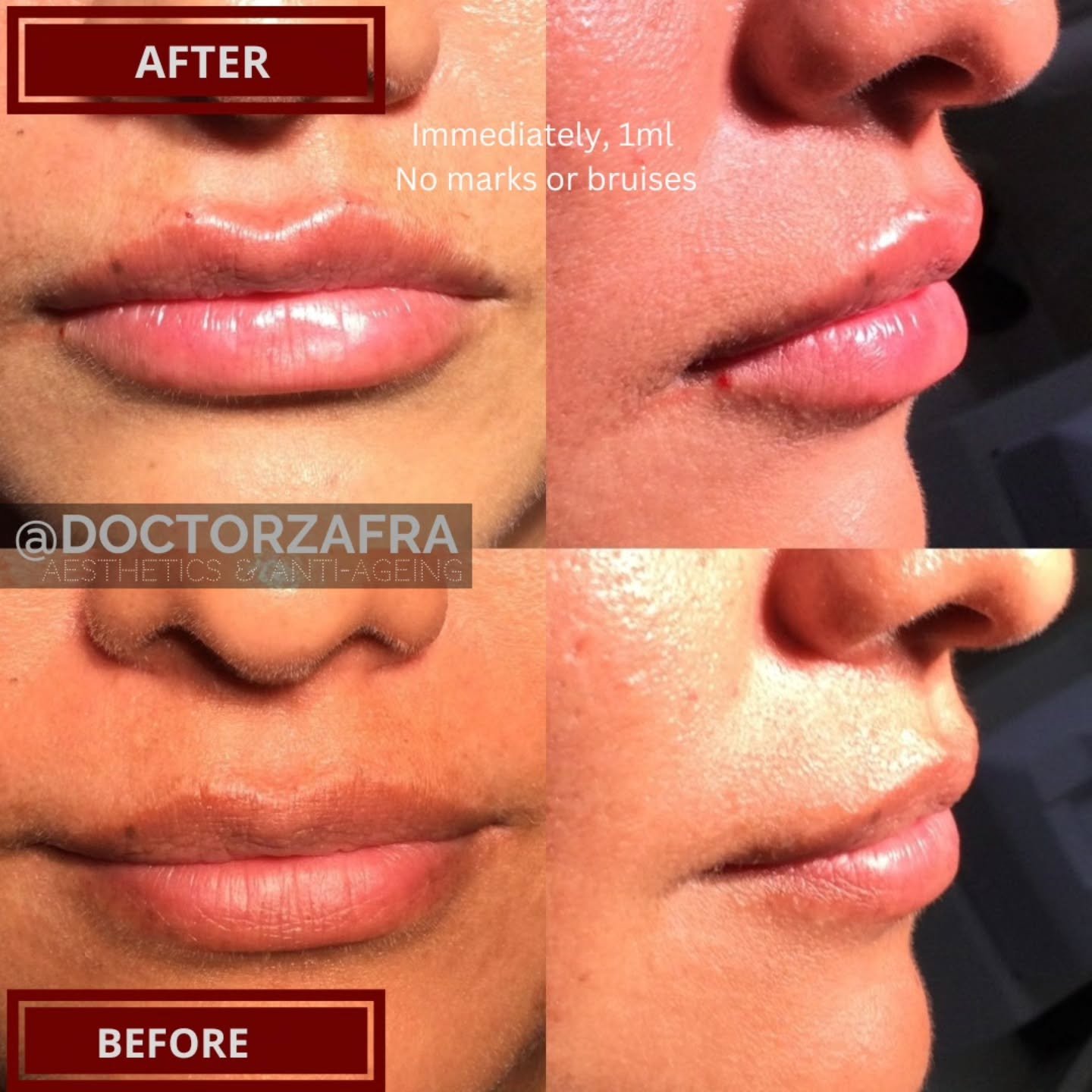 Definition and natural enhancement of lips💋 pictures speak for themselves 😉
✨️
This amazing result was achieved with 1 ml of hyaluronic acid dermal filler
❤
💎
💫
Age gracefully and with a little help, age beautifully 🥰
💎
Discover all we can do t