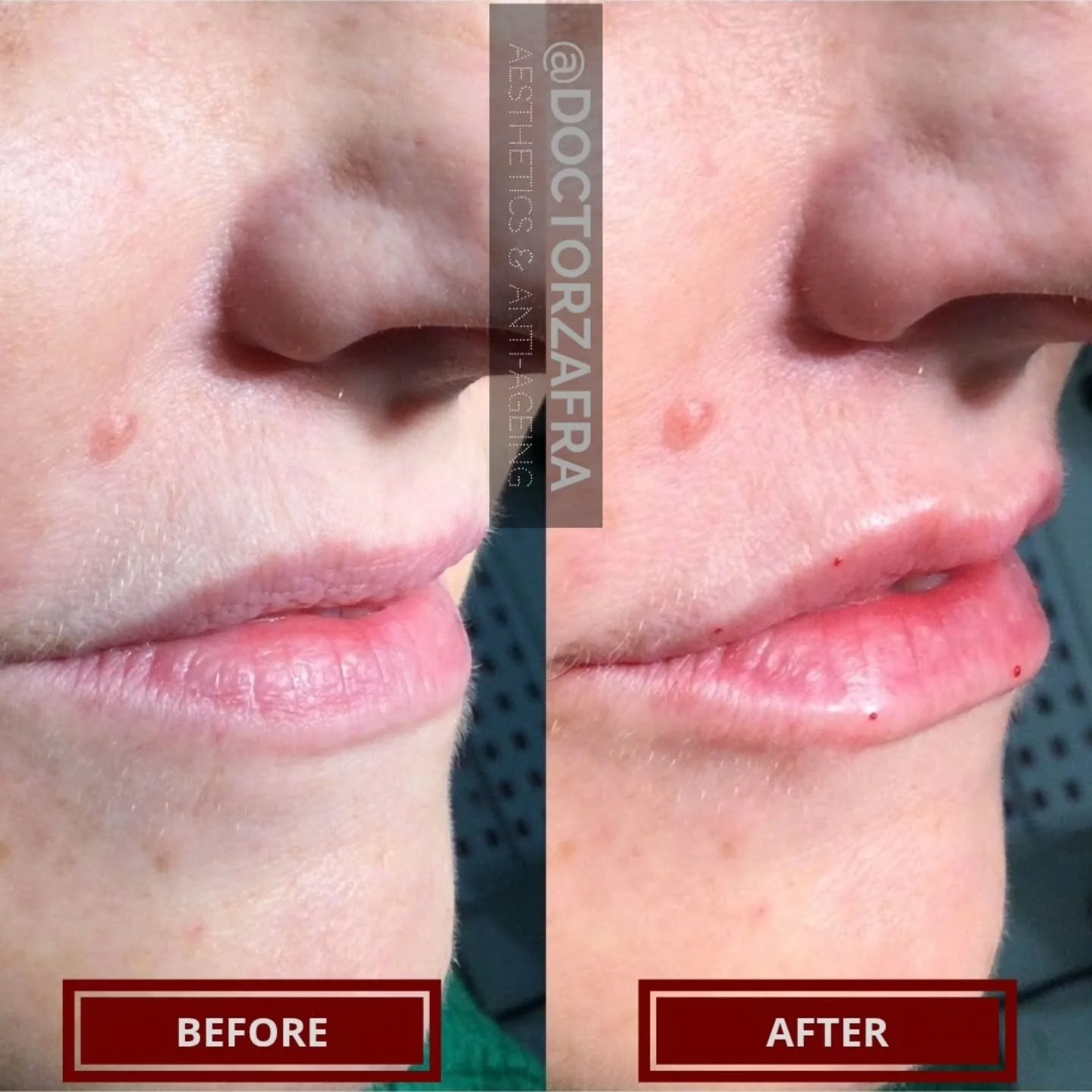 As we age, the lips not only lose volume but also lose the definition of the cupid's bow and become longer and flat 😪
⚠️
Wrong technique and product selection will result in a totally fake appearance, compared to a sausage 🌭, a duck 🦆 or a trout ?