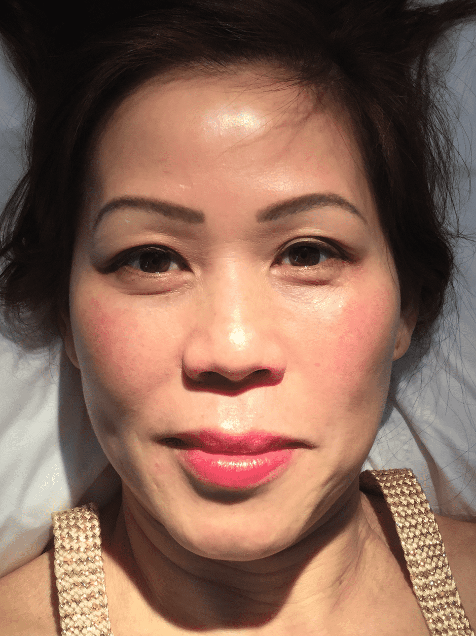 co2-laser-skin-treatment-after-woman-face-6.png
