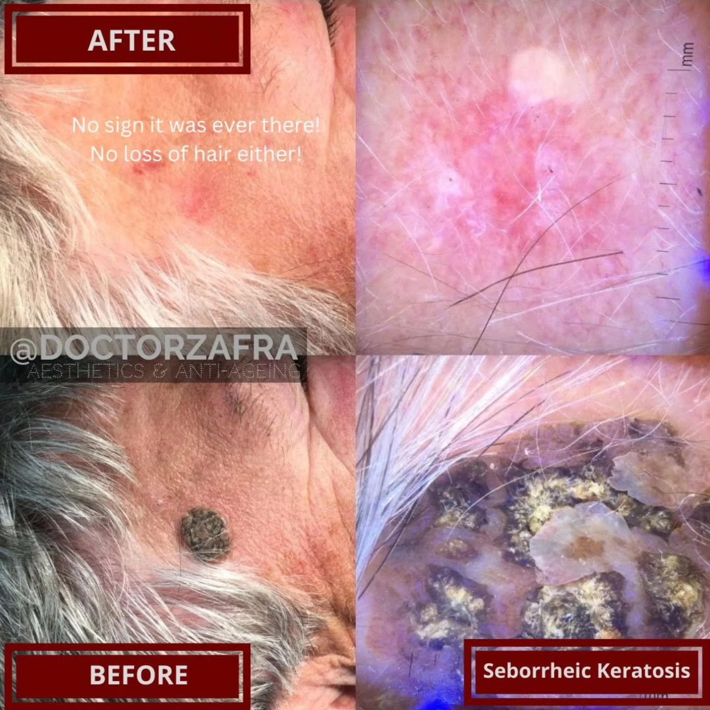 Yes this is possible without surgery at @zaframedical by @doctorzafra
🤩
Many patients of different ages are always afraid or nervous about having to get surgery to cut off a benign skin lesion. We do not cut we use lasers 😉 so you have nothing to w