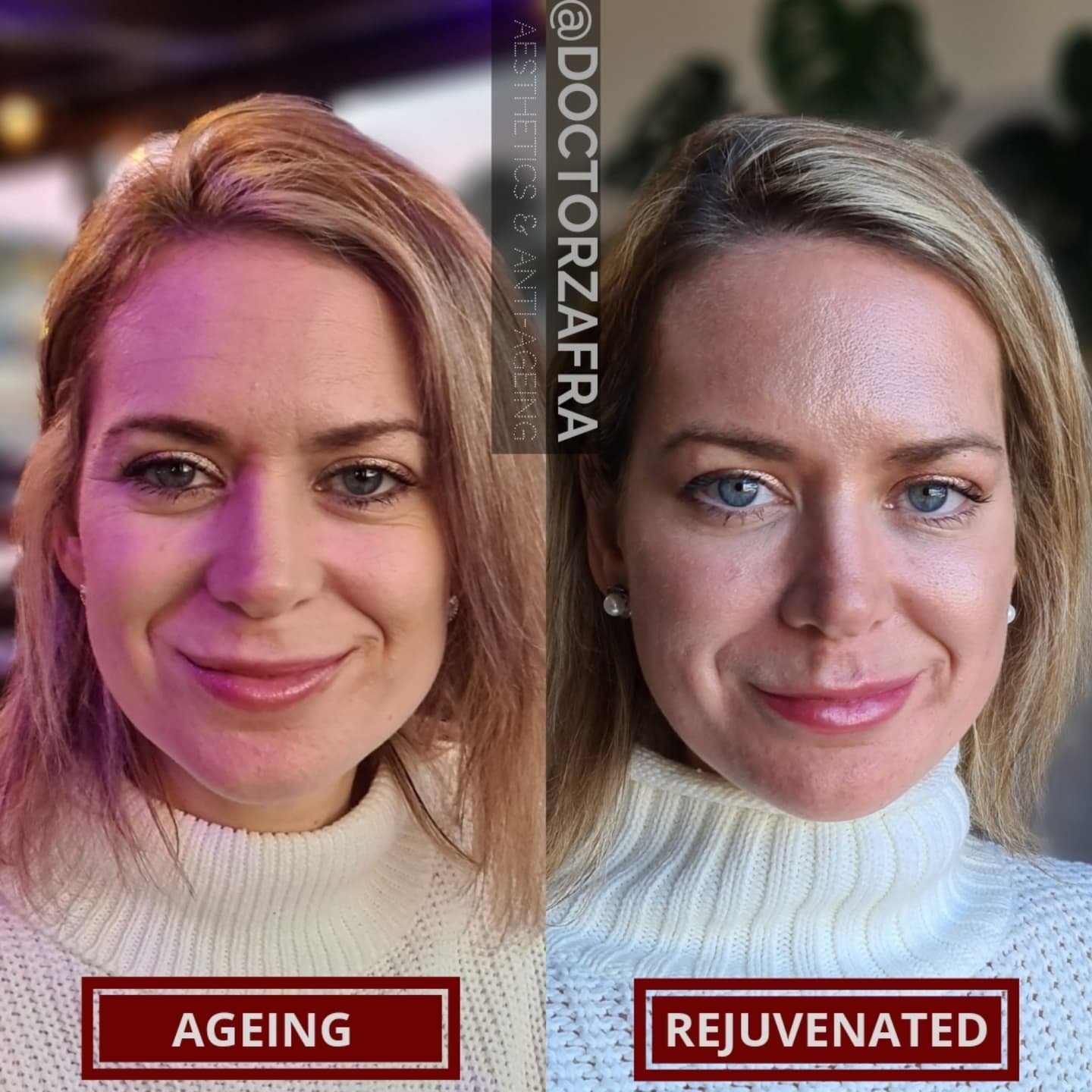 Years go by and if we haven't been religious with the sunscreen when we where young unfortunately time and gravity have a more intense effect on our skin and you can be young but have early signs of ageing 😔
⭐️
Fortunately @doctorzafra 's technics o