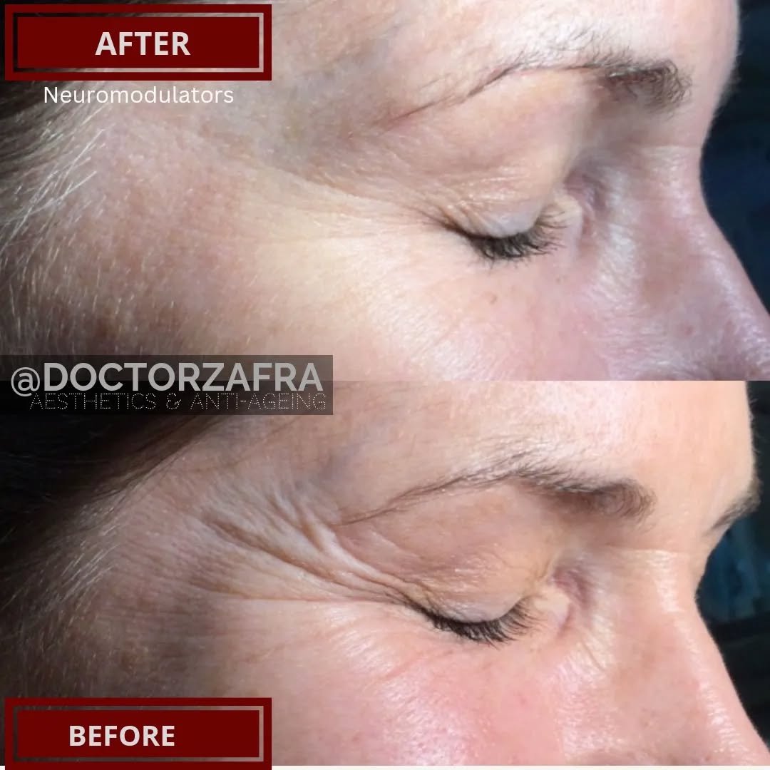 As we age due to the constant blinking and squinting, the skin basically cracks as it has less quality of collagen and wrinkles start appearing where there where lines of expression... and when se have them on the outer corner of our eyes, they are c