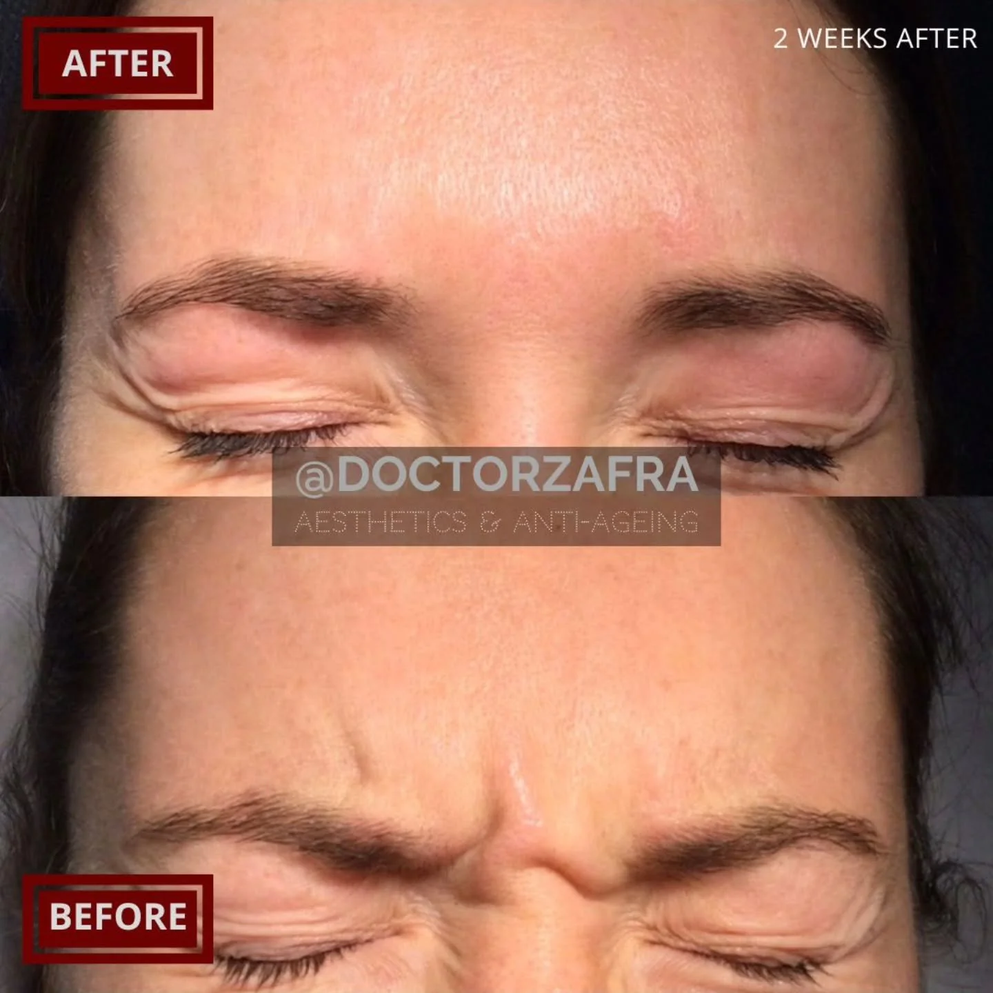 Dr Zafra @doctorzafra is a especialist in reassuring first time patients and delivering these amazing results, time after time and for a decade now in @zaframedical

This well known treatment is still feared and doubted do to loads of horrific storie