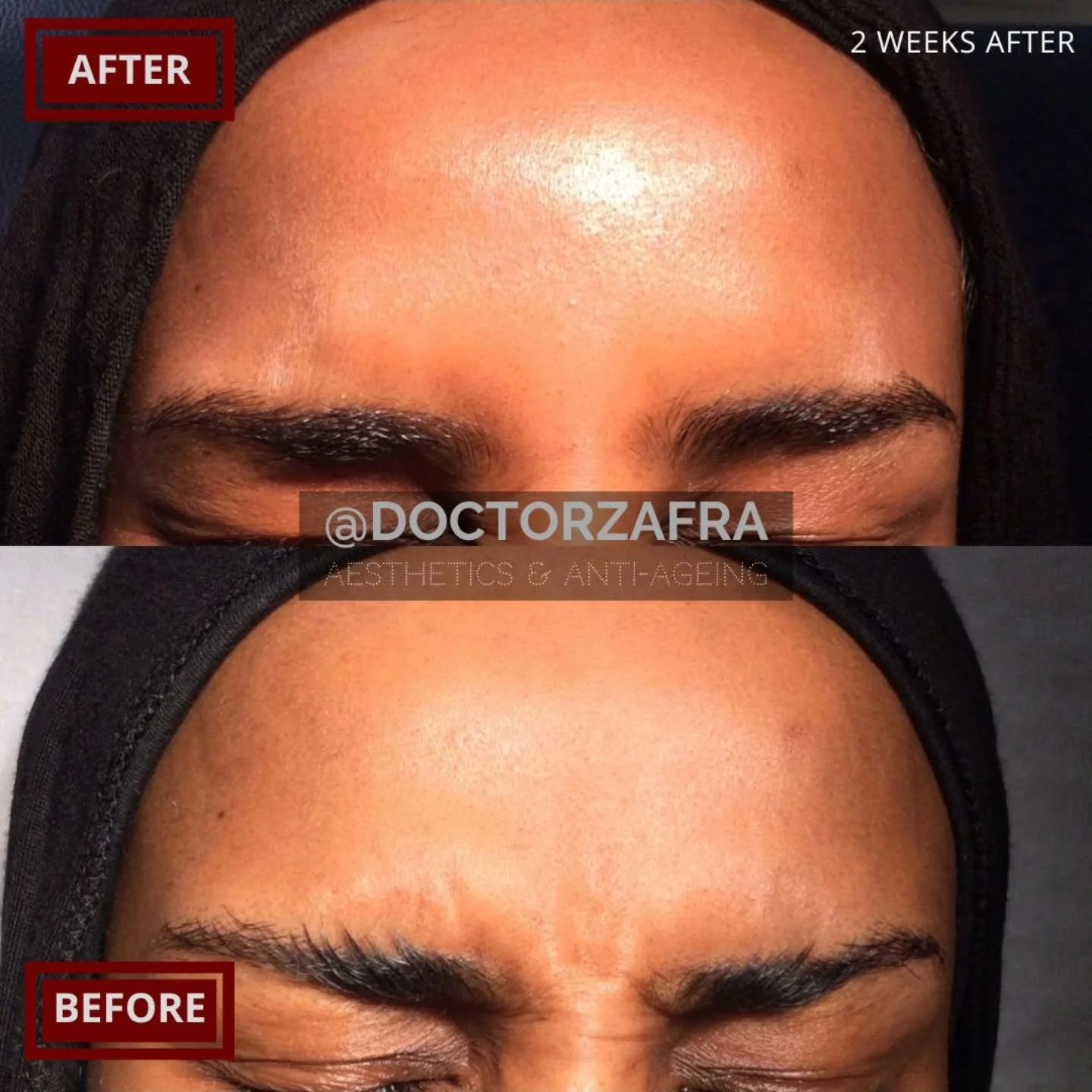 Wonderful results by @doctorzafra

Only after consultation can you discover which is the right treatment for your goals, so book in 

📸
An image is worth a thousand words, so no explanation is needed.
📷
💫
Age gracefully and with a little help, age