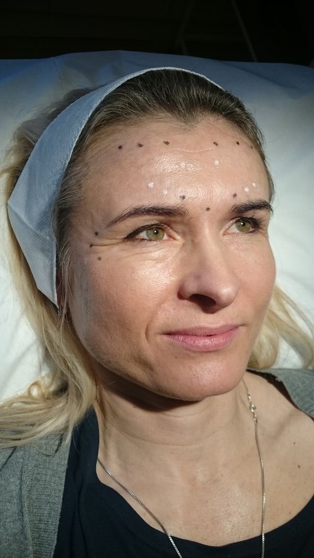 co2-laser-muscle-relaxing-treatment-before-woman-face.jpg