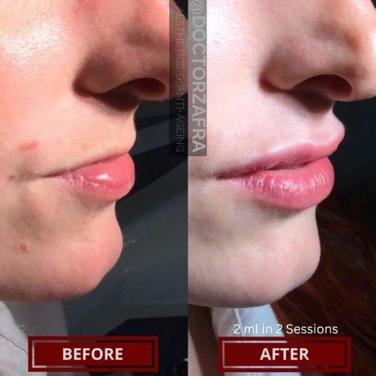 lip-dermal-filler.jpg