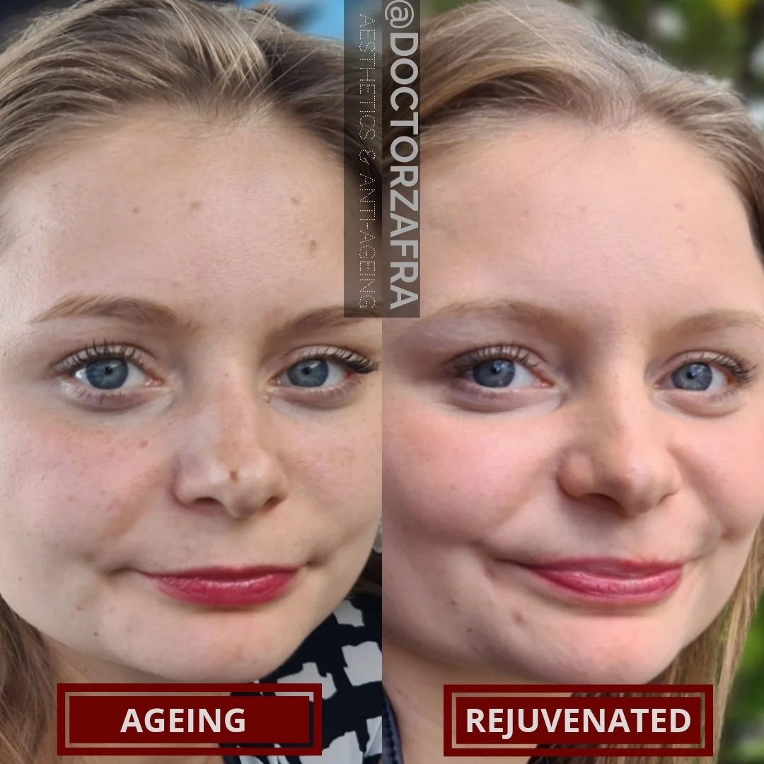 mole-removal-skin-improvement-before-after-case-8.jpg